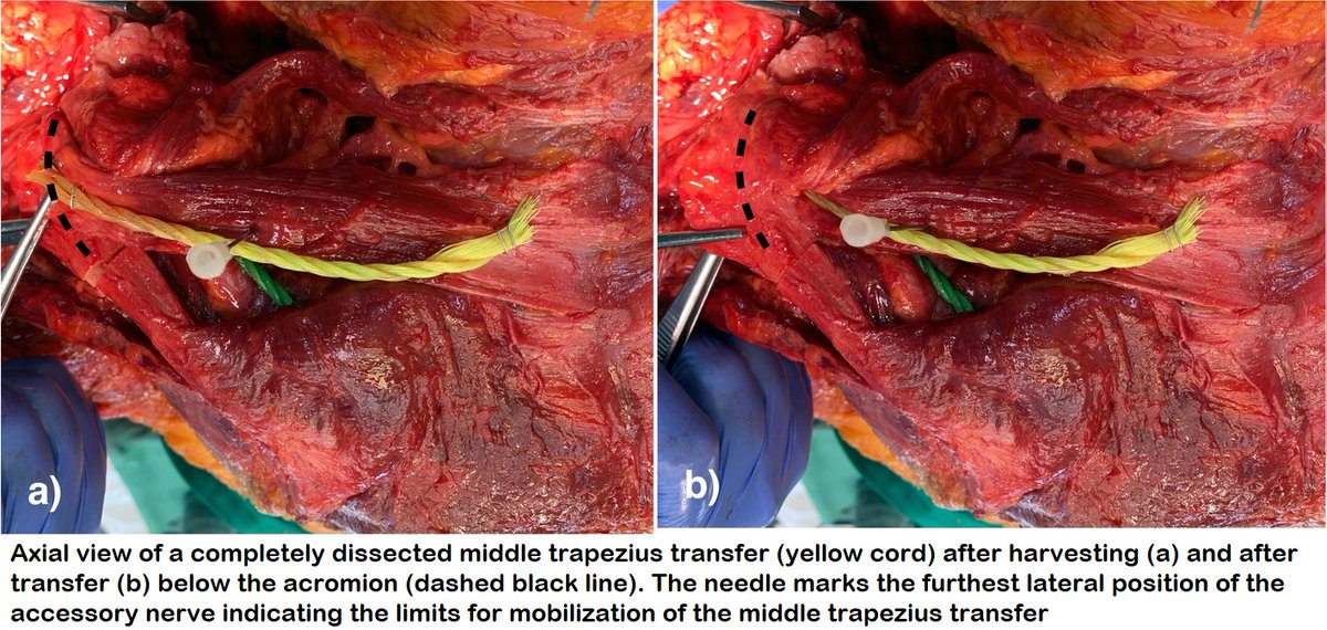 Tendon transfers are a complex solution to irreparable supraspinatus tendon tears with associated pain and loss of function.
This new Anatomic study by Moroder et al. explores the feasibility of doing a Middle trapezius transfer. 
Read it at: 
jeo-esska.springeropen.com/articles/10.11…