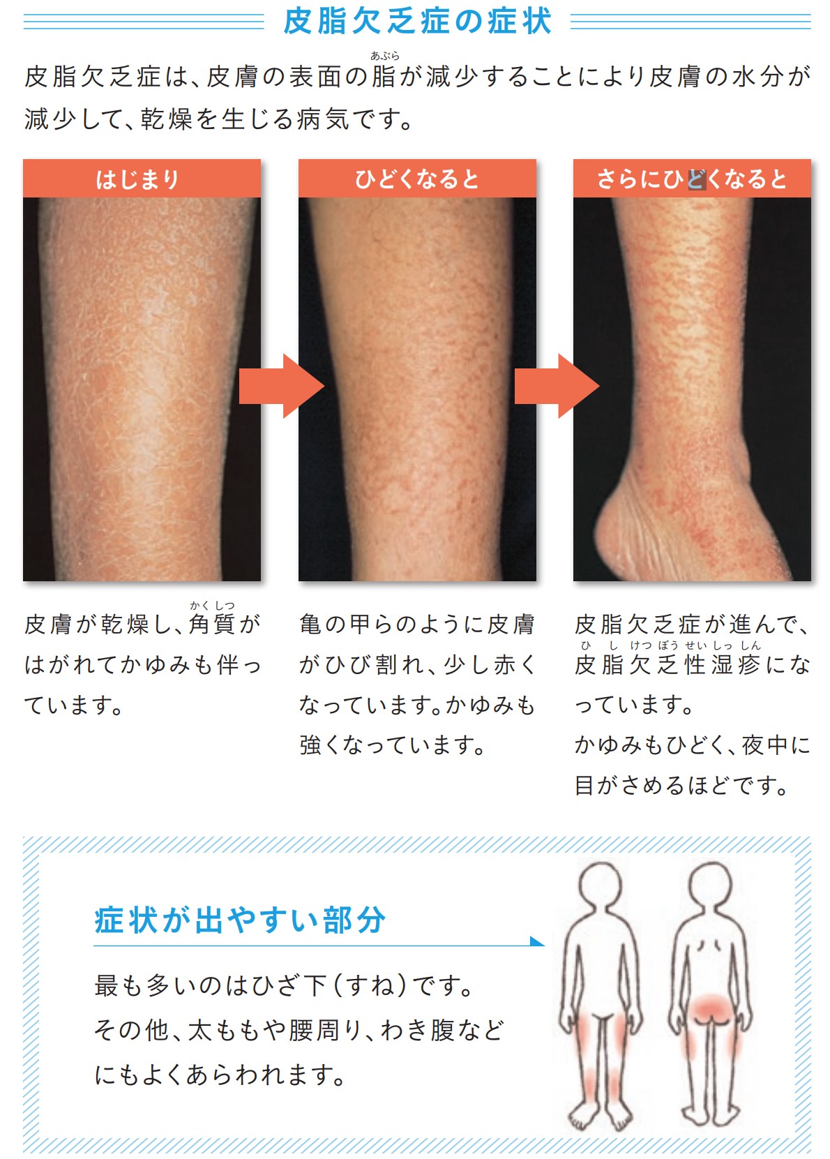 やさひふ クラファン中 Lumedia編集長 皮膚科専門医 医学博士 在 Twitter 上 乾燥肌をなめたらダメ 乾燥肌 皮脂欠乏症 乾皮症 を放置すると 皮脂欠乏症 カサカサ 皮脂欠乏性湿疹 ガサガサ 貨幣状湿疹 グジュグジュ 自家感作性皮膚炎 広範囲へ拡大