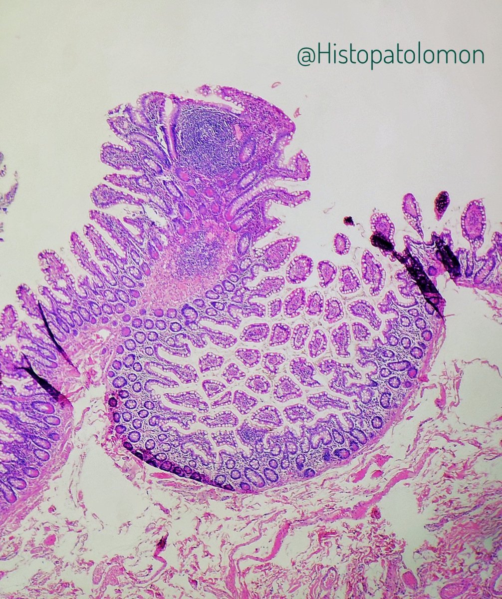 They are solitary lymphoid follicles, they are absolutely normal, it is estimated that there are thousands in the intestine, more frequent in the terminal ileum, where they coexist with Peyer's patches. They are part of the GALT system.  #GIpath  #SolitaryLymphoidFollicles