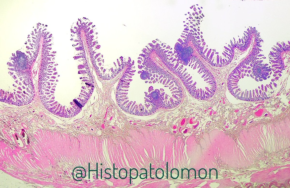 They are solitary lymphoid follicles, they are absolutely normal, it is estimated that there are thousands in the intestine, more frequent in the terminal ileum, where they coexist with Peyer's patches. They are part of the GALT system.  #GIpath  #SolitaryLymphoidFollicles