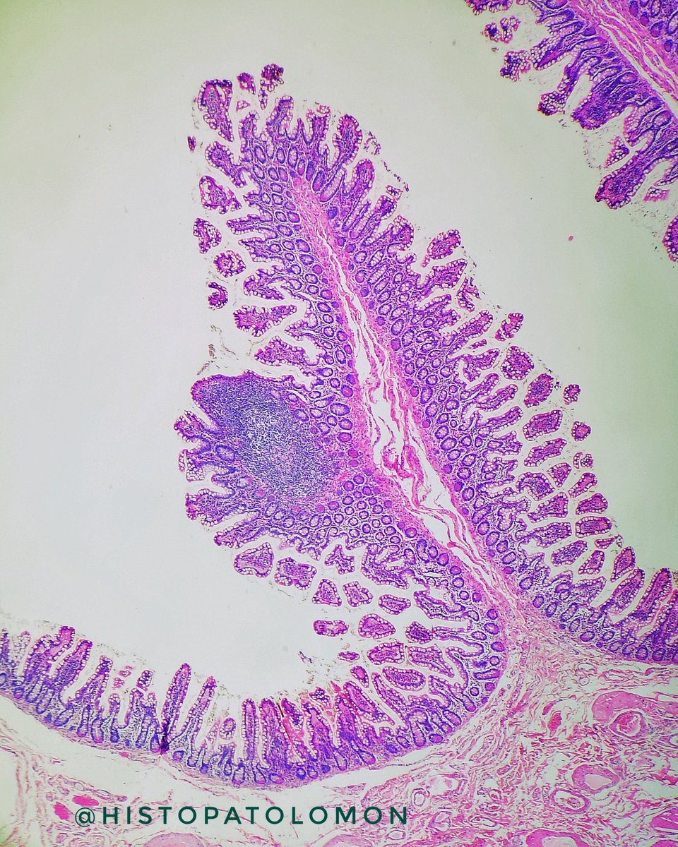 They are solitary lymphoid follicles, they are absolutely normal, it is estimated that there are thousands in the intestine, more frequent in the terminal ileum, where they coexist with Peyer's patches. They are part of the GALT system.  #GIpath  #SolitaryLymphoidFollicles