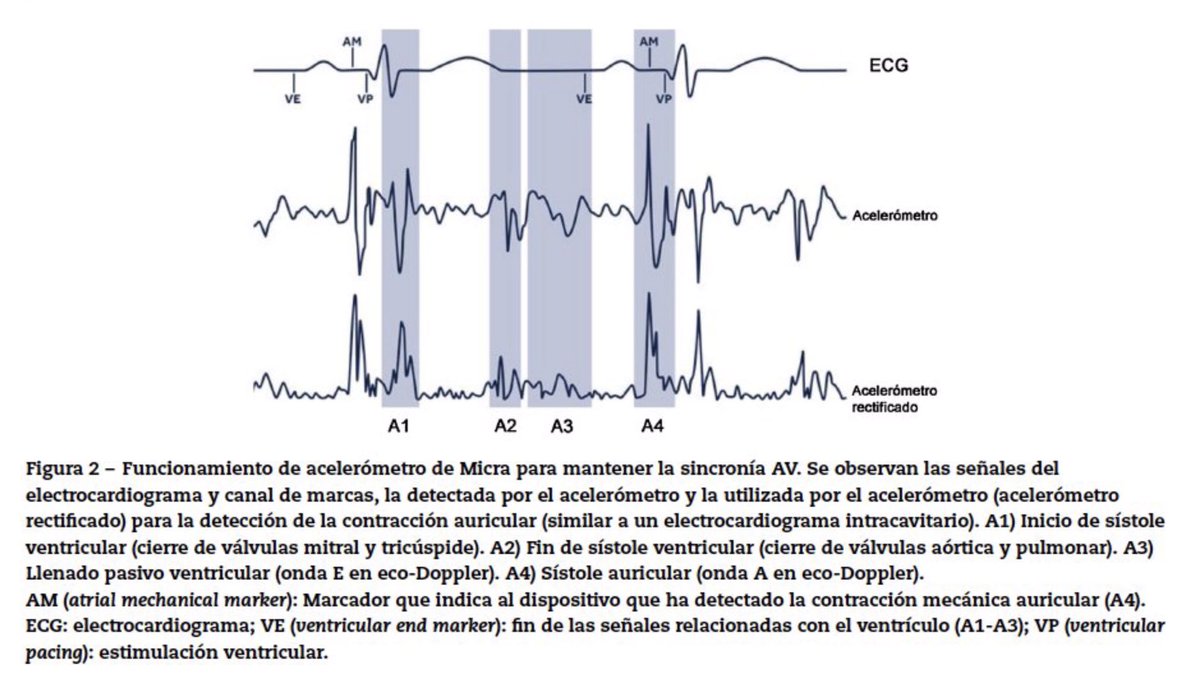 ritmo_SEC's tweet photo. ¿Habeis accedido ya al artículo: Lo mejor del año en estimulación cardiaca 2020?
 ¡Corre!, Pdf gratis.

Artículo liderado por la Dra. @MLFidalgoAndres.

https://t.co/2OmXOVoufM…

Lo último de lo último en estimulación fisiológica y marcapasos sin cables... @secardiologia https://t.co/N8IF61m507
