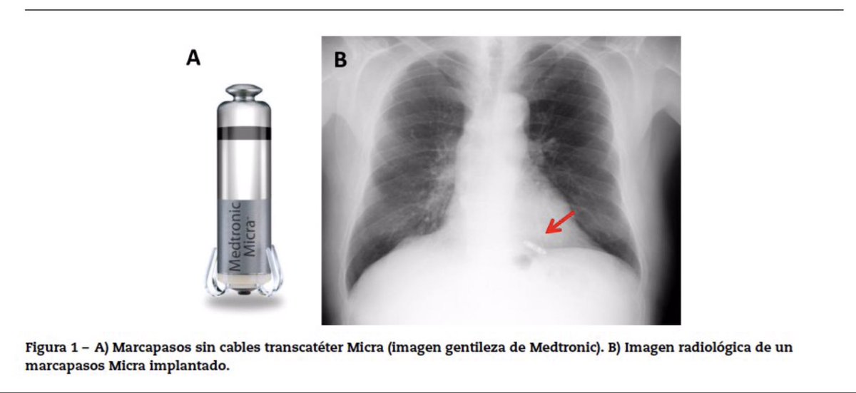 Asociación del Ritmo Cardiaco (@ritmo_sec) on Twitter photo ¿Habeis accedido ya al artículo: Lo mejor del año en estimulación cardiaca 2020?
¡Corre!, Pdf gratis.
Artículo liderado por la Dra. @MLFidalgoAndres.
authors.elsevier.com/c/1cMNi9GL~0I1…
Lo último de lo último en estimulación fisiológica y marcapasos sin cables... <a href="/secardiologia/">Soc Esp Cardiología</a> ¿Habeis accedido ya al artículo: Lo mejor del año en estimulación cardiaca 2020?
¡Corre!, Pdf gratis.
Artículo liderado por la Dra. @MLFidalgoAndres.
authors.elsevier.com/c/1cMNi9GL~0I1…
Lo último de lo último en estimulación fisiológica y marcapasos sin cables... <a href="/secardiologia/">Soc Esp Cardiología</a>
