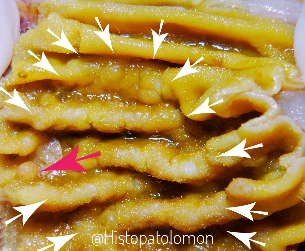 Peyer's patches are clusters of these follicles. This is a Peyer's patch. Also seen an isolated follicle (red arrow).  #GIpath  #PatchofPeyer