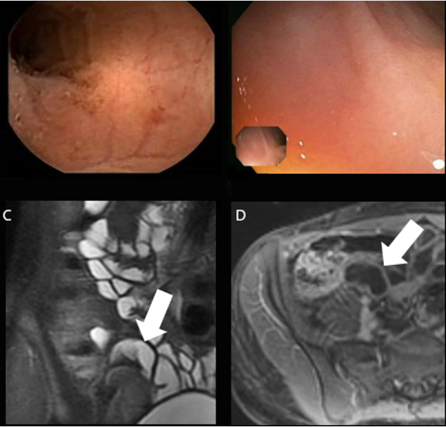 capsulendoscopy's tweet photo. Panenteric @capsulendoscopy vs ileocolonoscopy plus MRE in #crohnsdisease. https://t.co/ttVmO4ofXy https://t.co/74hvQlhYuW
