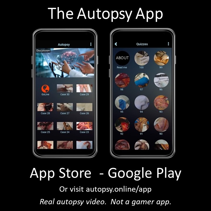 Download the #Autopsy App. Now on the App Store &amp; Google Play.  iPhone/Android compatible. Real autopsy video.  Not a gamer app. Quizzes. Discussion. Preview of Autopsy.Online, our master teaching platform. #Postmortem #Medicine #FutureDoctor #Premed #Anatomy #Forensics