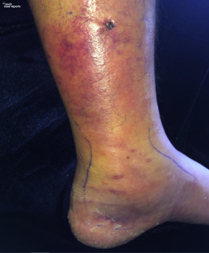 JAADjournals's tweet photo. Cutaneous extranodal natural killer/T-cell lymphoma mimicking cellulitis: A unique presentation https://t.co/wRm3KEkAl3 https://t.co/2RWKnMv0QO