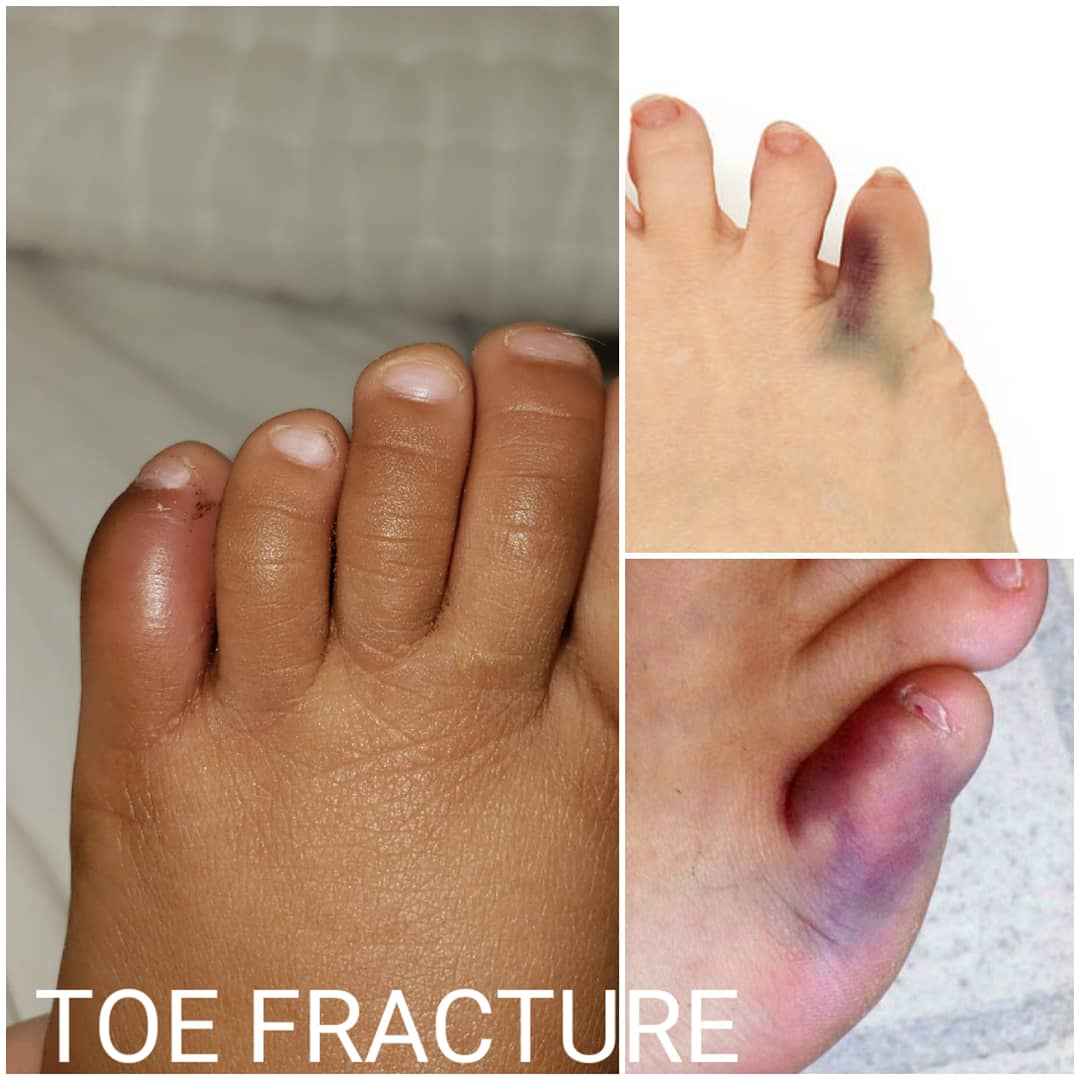 Bruising can appear less dramatic, or even unnoticeable, on darker skin. Here are comparisons of bruising on fractured toes (my child's poor little toe kindly provided the inspiration for this series 😬). #medtwitter #MedStudentTwitter #dermatology #BlackLivesMatter #NurseTwitter