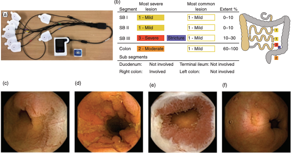 capsulendoscopy's tweet photo. Panenteric @capsulendoscopy  identifies
proximal small bowel disease guiding
upstaging and treatment intensification in
#crohnsdisease: #European multicentre
observational cohort study. https://t.co/okrLHICmn8 https://t.co/o7XiA33m6e
