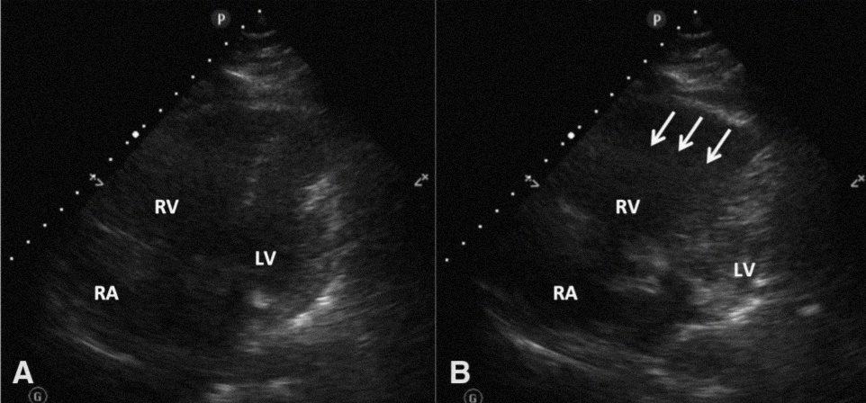 Finally, I'll leave a cool case by  @BrooksWalsh of a pt w/ McConell's and no vascular occlusion on CTA. Hope you've enjoyed the thread!DOI: 10.1016/j.jemermed.2014.12.089