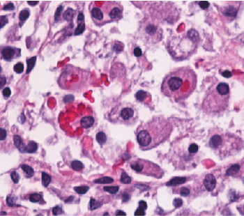 Sharing one of my favourite slides from autopsy case. Hemophagocytic lymphohistiocytosis: Macrophages behaving badly, devouring an innocent red blood cells (AKA Erythrophagocytosis). Overall mortality &gt;60%. Ddx: Rosai-Dorfman Disease (lymphocytophagocytosis)