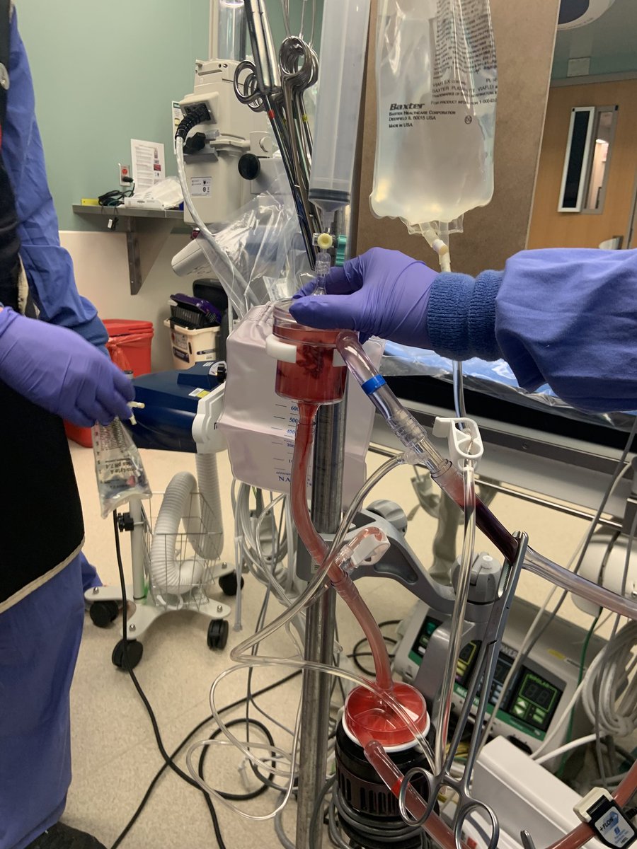 1/6 Successful removal of TV Vegetation using AngioVac