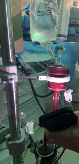 1/6 Successful removal of TV Vegetation using AngioVac