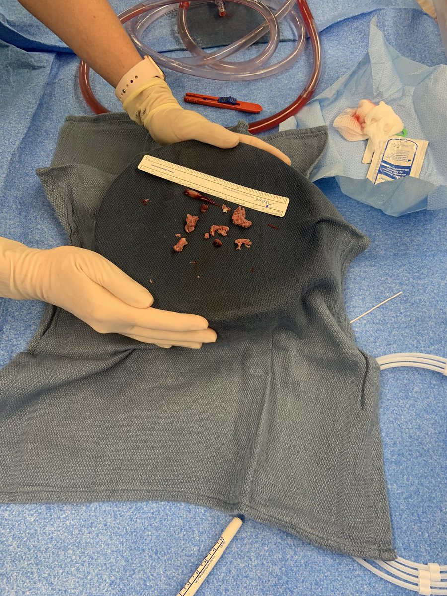 1/6 Successful removal of TV Vegetation using AngioVac