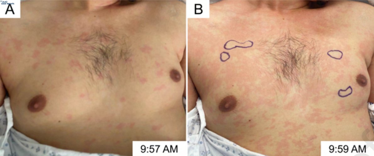 Rapidly migrating macular pink patches in an unresponsive patient. Possible CNS-driven autonomic neurovascular dysregulation. Note the timestamp on the images. bit.ly/2M5QRb4