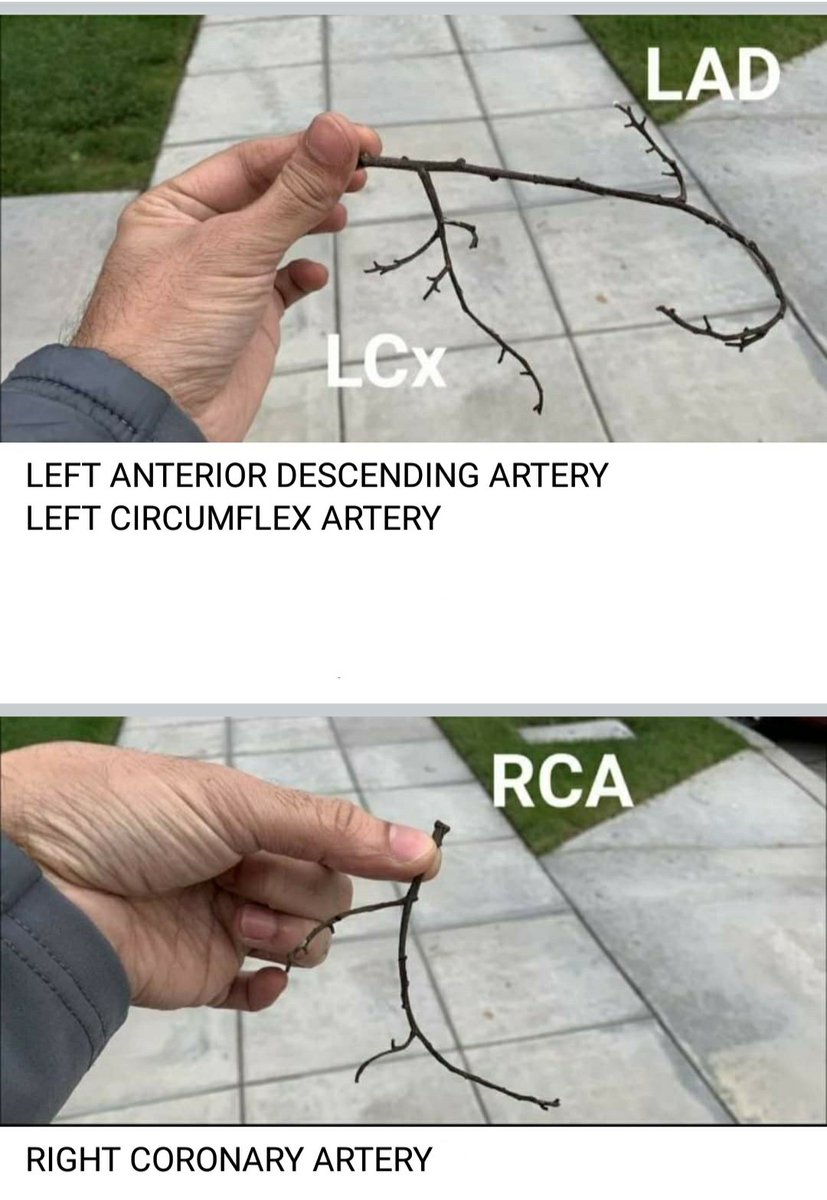 Quick and easy way to learn anatomy of coronary arteries 😃
