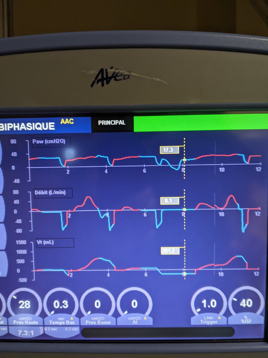 phil_starno's tweet photo. After 8 hours on APRV-TCAV (9:30pm)
∆P 11, FiO2 40%, SpO2 99.
("Auto-peep with 75% PEFR at 17) https://t.co/QkD2c7c7c2