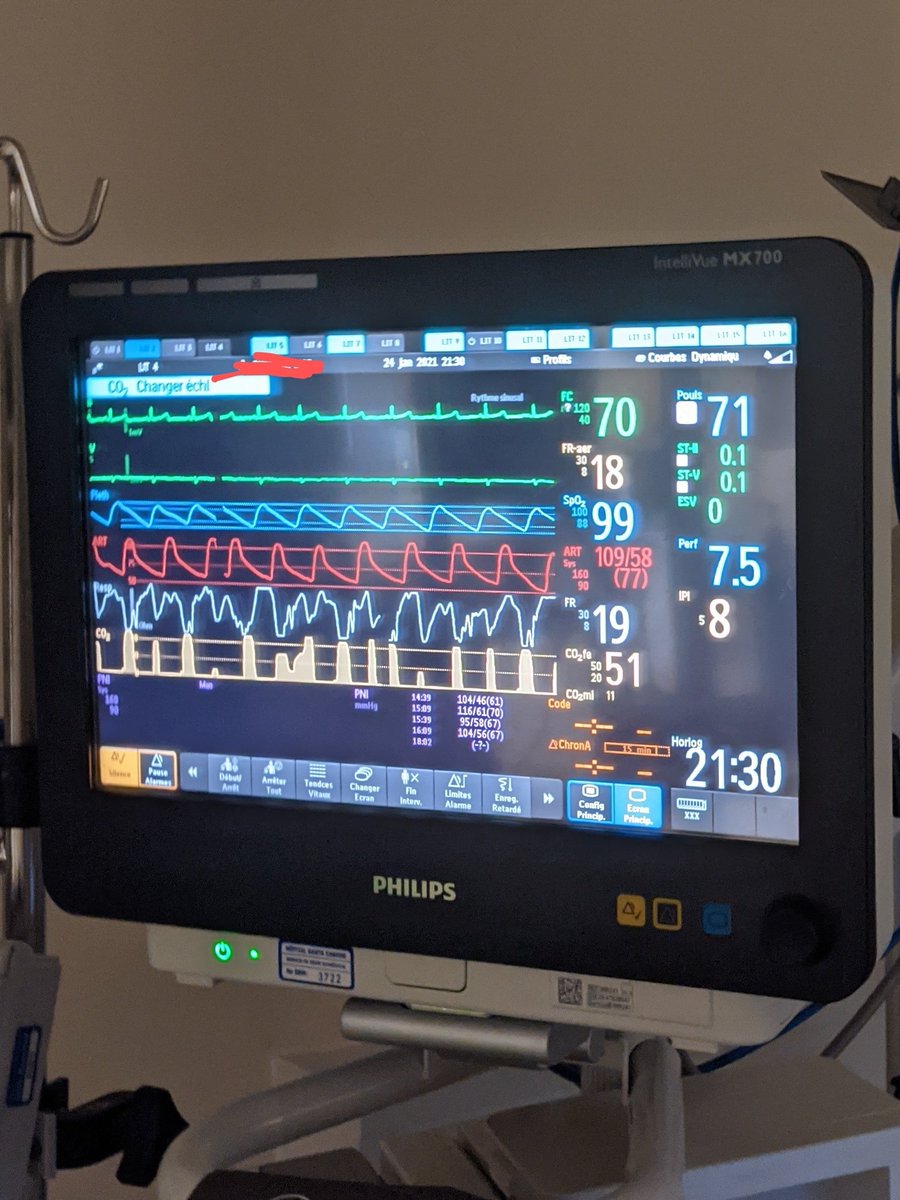 phil_starno's tweet photo. After 8 hours on APRV-TCAV (9:30pm)
∆P 11, FiO2 40%, SpO2 99.
("Auto-peep with 75% PEFR at 17) https://t.co/QkD2c7c7c2