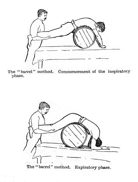 We didn't create the Chain of Survival overnight, in fact it's taken centuries of innovation to make it from flogging patients or rolling them on wine barrels to high performance CPR.Although hopefully our modern experiments won't seem so surreal in 150 years. 1/x