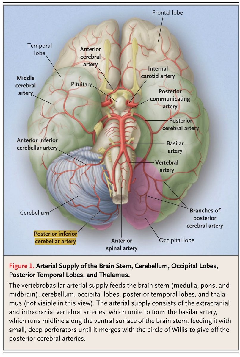 Jcortesizaguirr's tweet image. #WallenbergSyndrome

#Ipsilateral
↓pain/temp in the face➡️ trigeminal nucleus
Dysphagia, ↓gag reflex➡️ N. ambiguus
Ataxia ➡️ inferior cerebellar peduncle
Horner syndrome➡️sympathetic 
Vertigo, nystagmus ➡️ vestibular

#Contralateral
↓ pain/temperature in trunk and limbs