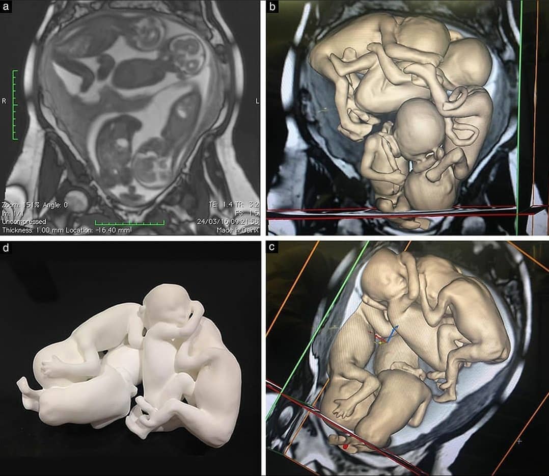 In-vitro Fertilization memberikan Wanita usia 32 thn yg telah mendambakan keturunam selama 4 tahun, bayi kembar 4.

📸: Posisi janin saat usia kehamilan 6 bulan melalui 3D MRI via Medicosity. (1/2)