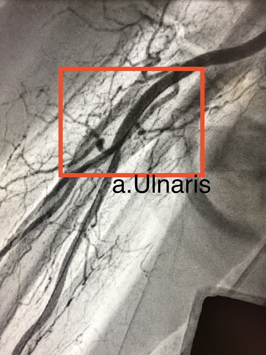 PeterGrewe3's tweet photo. #radialisfirst #ulnarisalternativ in this case ulnaris first ! https://t.co/VR8DICABah