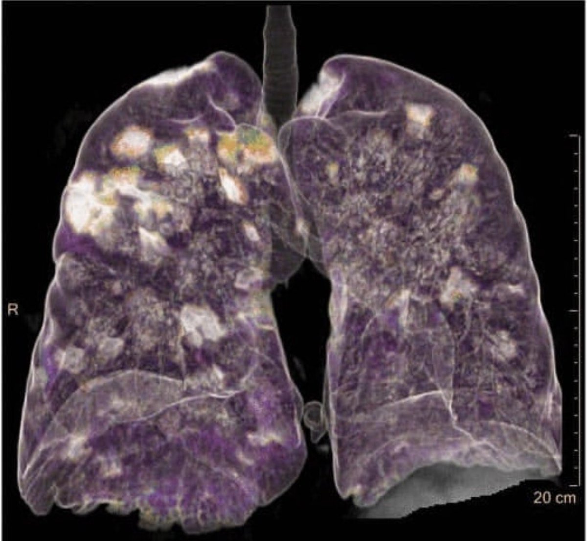 3D CT of Novel coronavirus (Covid-19) pneumonia 

Please stay safe out there

#COVID19Nigeria 
#Kestology