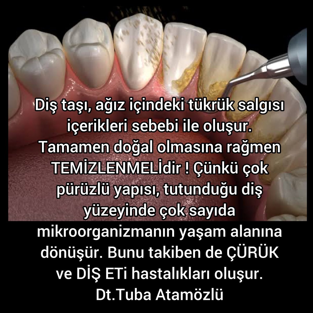 #Diştaşı #ağız içindeki #tükrük salgısı içerikleri sebebi ile oluşur. Tamamen doğal olmasına rağmen TEMİZLENMELİdir ! Çünkü çok pürüzlü yapısı, tutunduğu #diş yüzeyinde çok sayıda mikroorganizmanın yaşam alanına dönüşür. Bunu takiben de #ÇÜRÜK ve DİŞ ETi hastalıkları oluşur.
