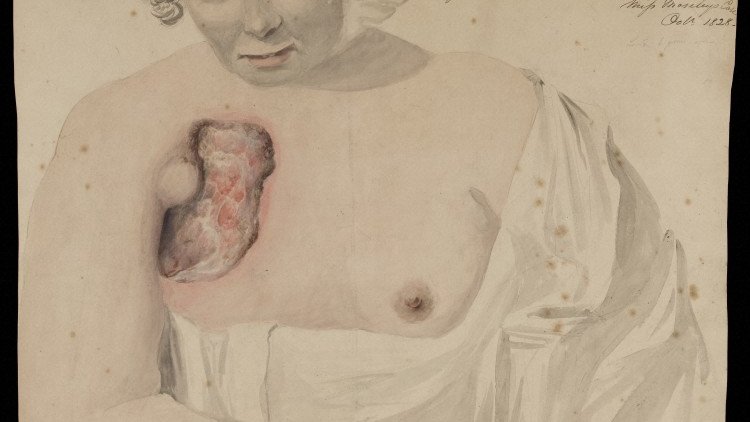 In contact with the skin or malignant mass, these substances would burn through flesh and could be reapplied until the tumour had been completely eaten away. 3/12