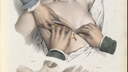 Much like surgery, practitioners knew that these efforts would only temporary alleviate suffering and that they were unlikely to completely cure patients of malignant disease. They knew that cancer could spread around the body, metastasise, and reappear elsewhere. 5/12