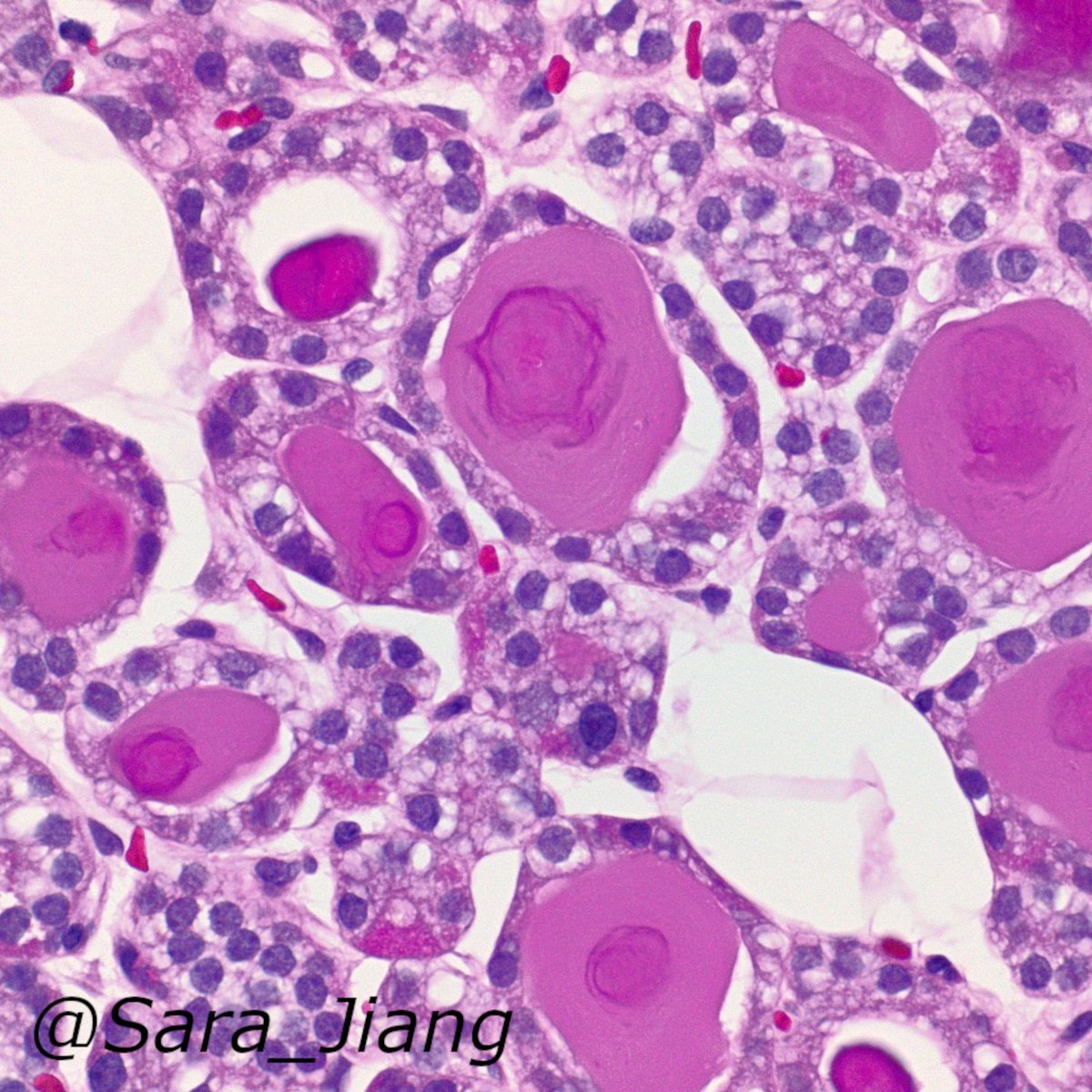 #PathPitfall, Frozens edition:
Pseudofollicular change can occur in parathyroid (seen here) - easy to mistake for thyroid tissue on a small sample on frozens! Tips: if you see crystals in the "colloid", likely to be truly thyroid: pubmed.ncbi.nlm.nih.gov/24618617/