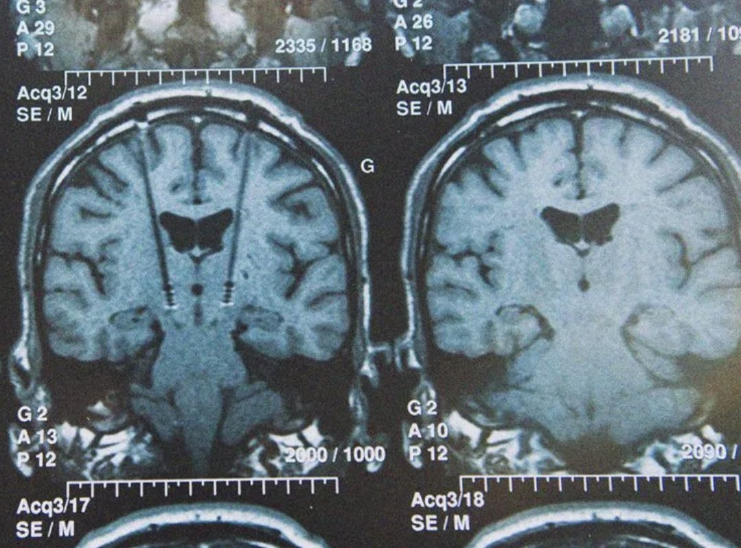 walsh_paper's tweet photo. 'A new case study from #UCSF suggests adapting deep brain stimulation to a patientโs individual needs could relieve #Depression symptoms at least temporarily.'
Article here: https://t.co/UHQCAM6gO0
#FollowUsPlease #WalshPaper
#ParchmentSupplier #Brain #Science https://t.co/gZtvMhgc0h