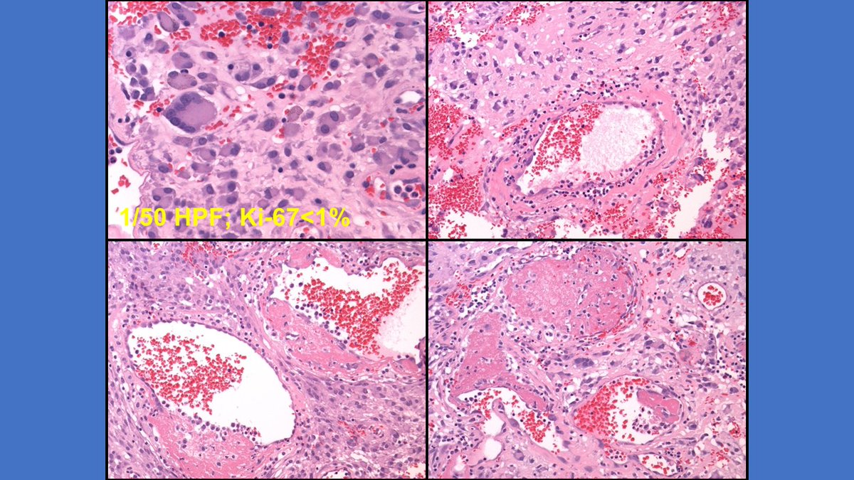 Retroperitoneal tumour