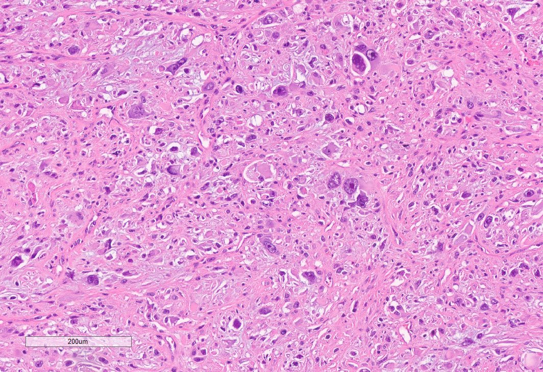 Two sections from within the same kidney tumor. I received a LN biopsy a few months later, that looks like the 2nd pic. Without the prior, it would have been difficult to classify solely on the HG component. 

Dx: Chromophobe RCC with sarcomatoid dedifferentiation. #GUPath