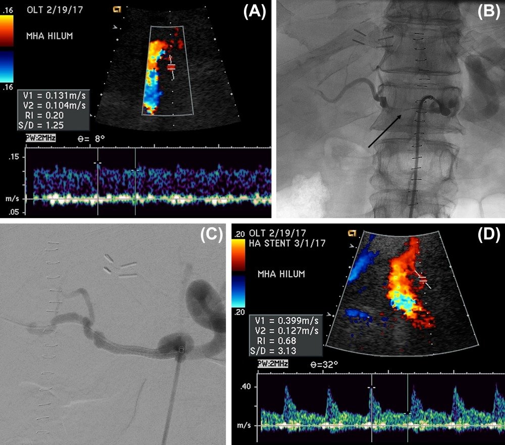 Your friendly IR is just around the corner!The authors discuss how IR can help manage hepatic artery thrombosis and hepatic artery stenosis.
