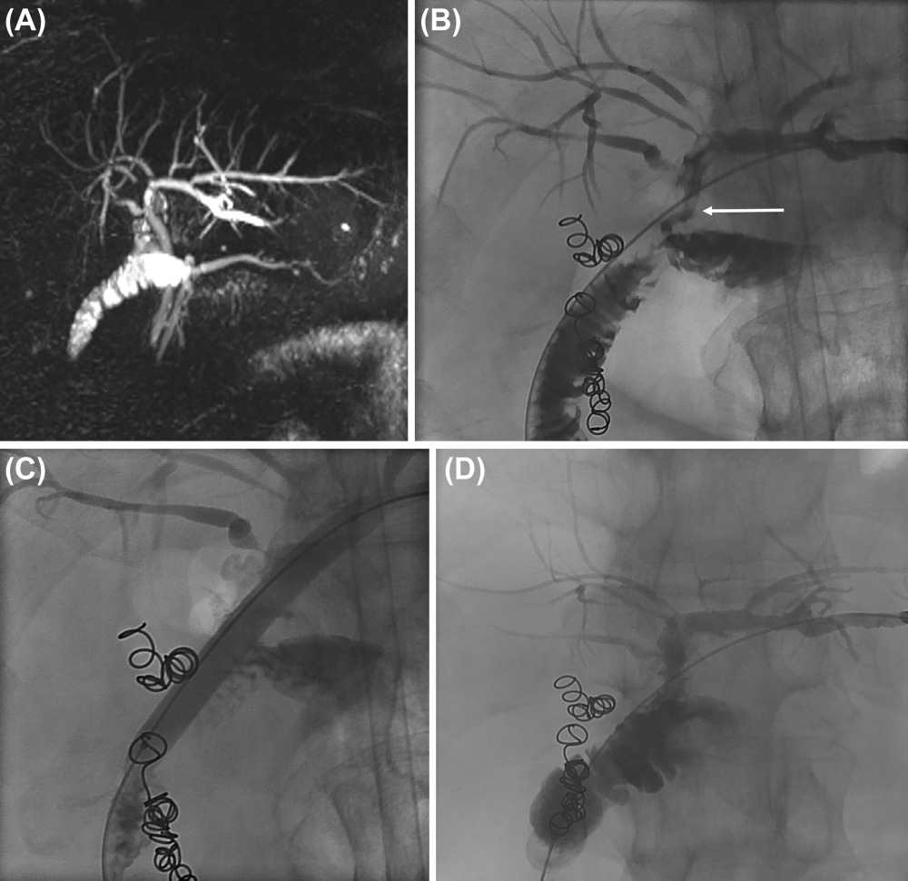 Finally, biliary complications are the most common anastomotic complication. IR can really help you when you're in a tightspot.