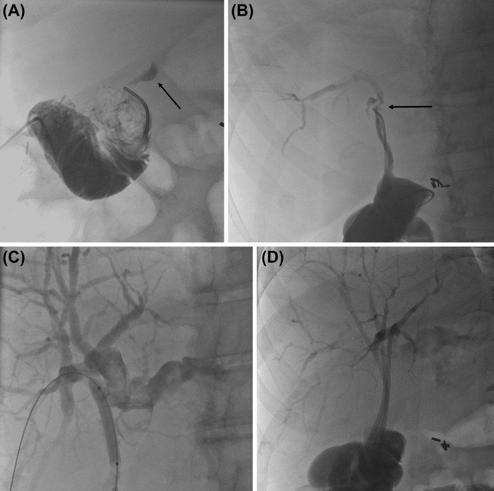 Finally, biliary complications are the most common anastomotic complication. IR can really help you when you're in a tightspot.