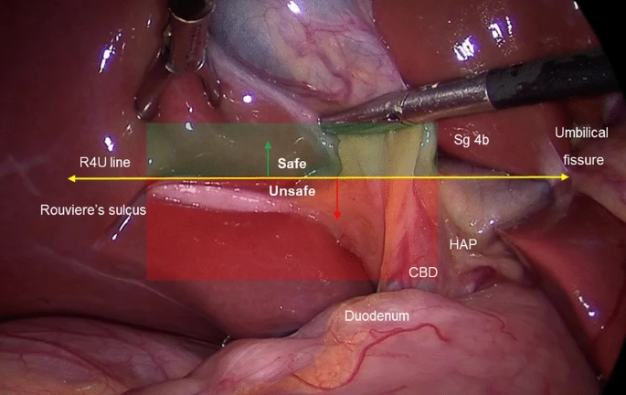 WorldJSurg's tweet photo. Innovative Surgical Techniques Around the World ➡️ The R4U Planes for the Zonal Demarcation for Safe Laparoscopic Cholecystectomy

🆓🔗 https://t.co/W8JB8gztLA

'Describe a technique of zonal demarcation based on the concept of one line, two planes &amp; four zones...' https://t.co/V2hIp5MC3w