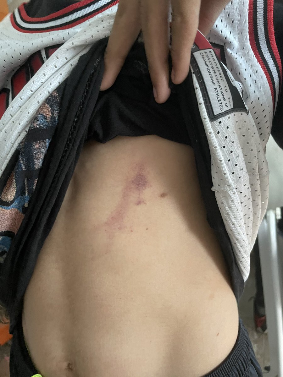 AngelyMorenoRD's tweet image. .@PoliciaRD arresta adolescente de 16 años sentado en el frente de su casa a las 10:00 de la mañana, lo llevan al destacamento y un tal Prospecto del destacamento de Villa Duarte Santo Domingo Este le entra a patadas...Todo el tiempo le dijeron que era un menor de edad animales!!