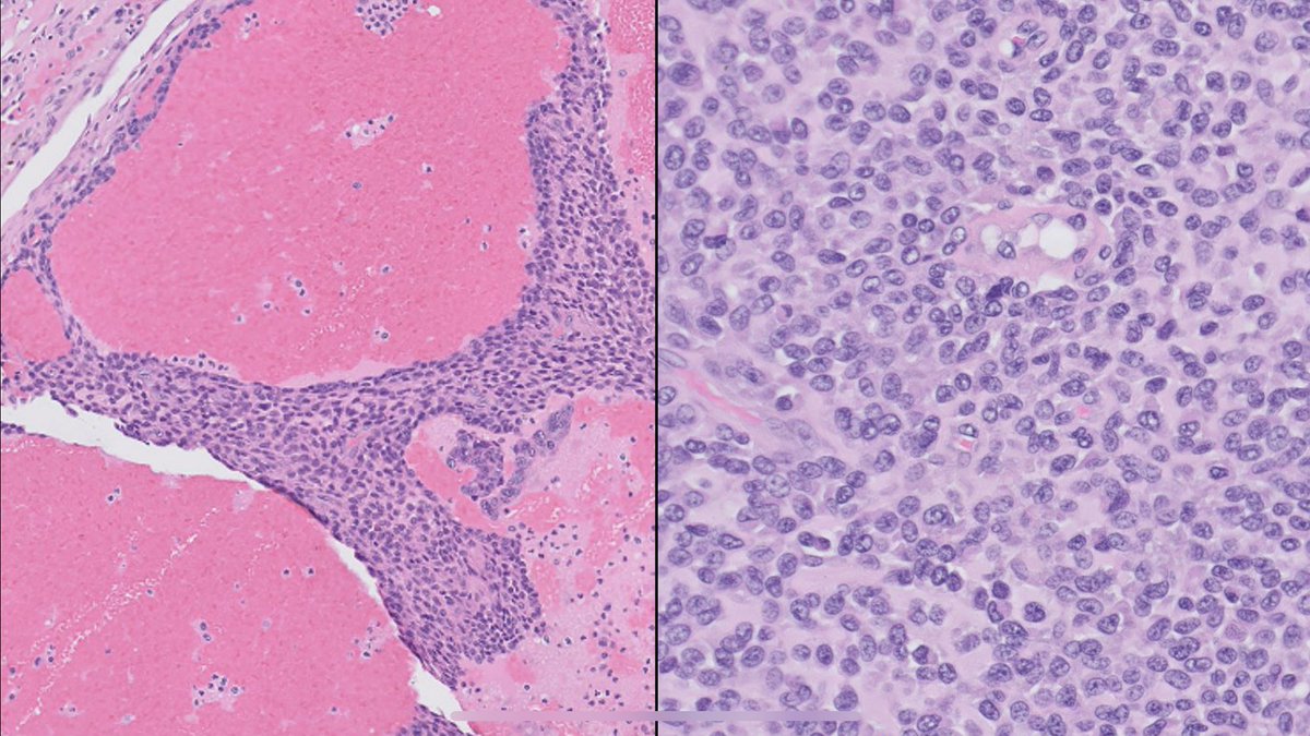 Meghana Agni MD (@meghanaagnimd) on Twitter photo Just presented this to the
<a href="/ChicagoPathSoc/">Chicago Pathology Society</a>!
51 yo M presented w/ painful mid-back lump that grew rapidly over a few weeks. He had a 30 lb weight loss over 3 mo, fatigue, and severe anemia. MRI: 5.6 x 4.3 x 3.6 cm paraspinal soft tissue mass. Your #DDx? <a href="/UChicagoPath/">University of Chicago Pathology</a> #IRAP21 Just presented this to the
<a href="/ChicagoPathSoc/">Chicago Pathology Society</a>!
51 yo M presented w/ painful mid-back lump that grew rapidly over a few weeks. He had a 30 lb weight loss over 3 mo, fatigue, and severe anemia. MRI: 5.6 x 4.3 x 3.6 cm paraspinal soft tissue mass. Your #DDx? <a href="/UChicagoPath/">University of Chicago Pathology</a> #IRAP21