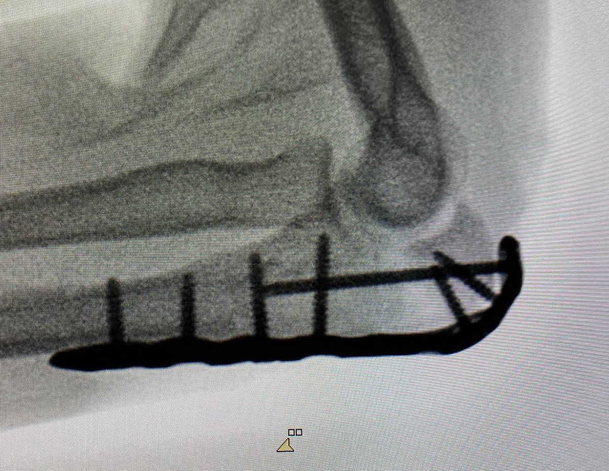 HMarquina_COT's tweet photo. ¡Ojo! A pesar de la pandemia seguimos teniendo fracturas que necesitan cirugía.
Mujer 47 años, caída en bicicleta y fractura de olecranon tratada mediante osteosíntesis con placa bloqueada. #fracturemonday #orthotwitter #orthopaedic @Vithas #Medimar https://t.co/eiVpRLmlbC