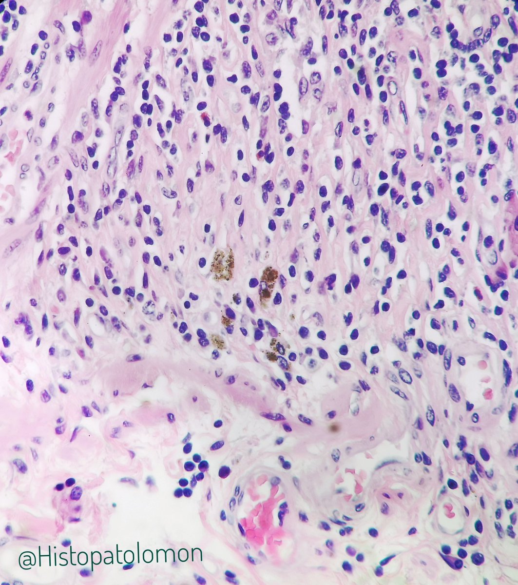 A characteristic of Peyer's patches in adults is the presence of macrophages with brown pigment at the base. It is known as titanium pigment, although in addition to Ti, aluminum, silicates and other substances have been found.Black Peyer's patches have been seen in coal miners.