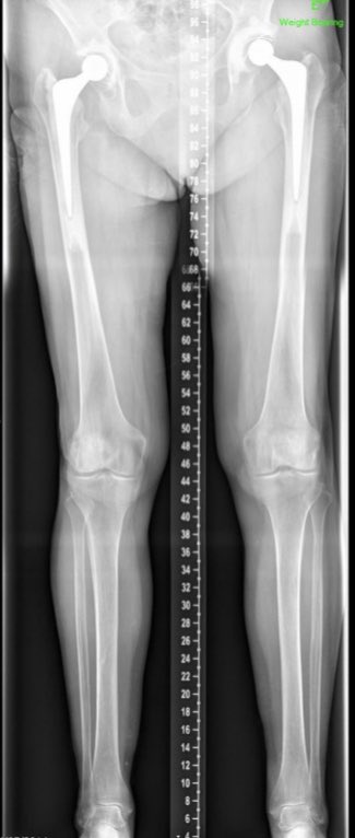 Leg length films really helpful for planning in many cases like this & with congenital proximal femoral deformity. The challenges in operating here are multiple1. Will it help pain2. How can you correct issues3. Will reducing length and offset de- tension and risk instability