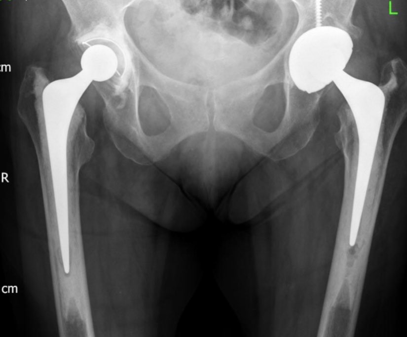 And here are the pre and post op films. Correction of length and offset. So far (several years) a stable hip and a delighted patient. Thankfully.