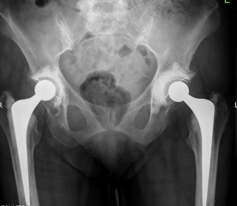 And here are the pre and post op films. Correction of length and offset. So far (several years) a stable hip and a delighted patient. Thankfully.