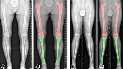 Radiology_AI's tweet photo. Fast, accurate #DeepLearning method to measure bone length and assess lower extremity alignment https://t.co/JJZBRFk1EW @justusschock @UniklinikDUS #LegLength #AI #MachineLearning https://t.co/3JkSXF7PuL