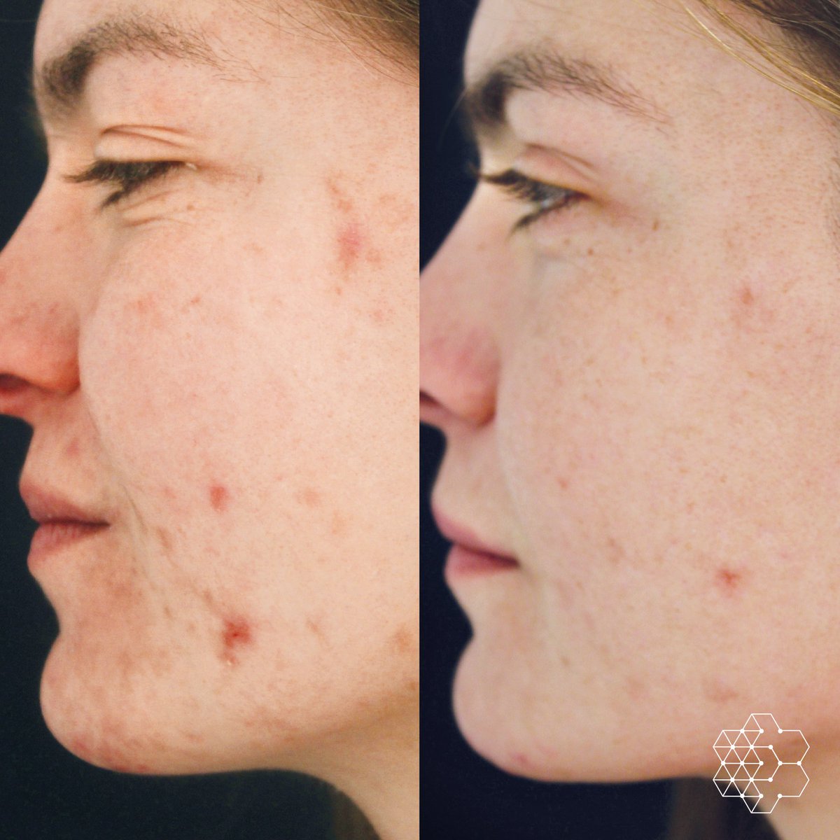 drpavlou's tweet photo. In addition to treating #acne, our #chemicalpeels treat skin concerns such as poor texture, lack of radiance, enlarged pores, #brownspots, and even #wrinkles. Couple this with the right medical grade skin care and your skin will be clearer, brighter and even younger looking. https://t.co/vNLZ75AvVA