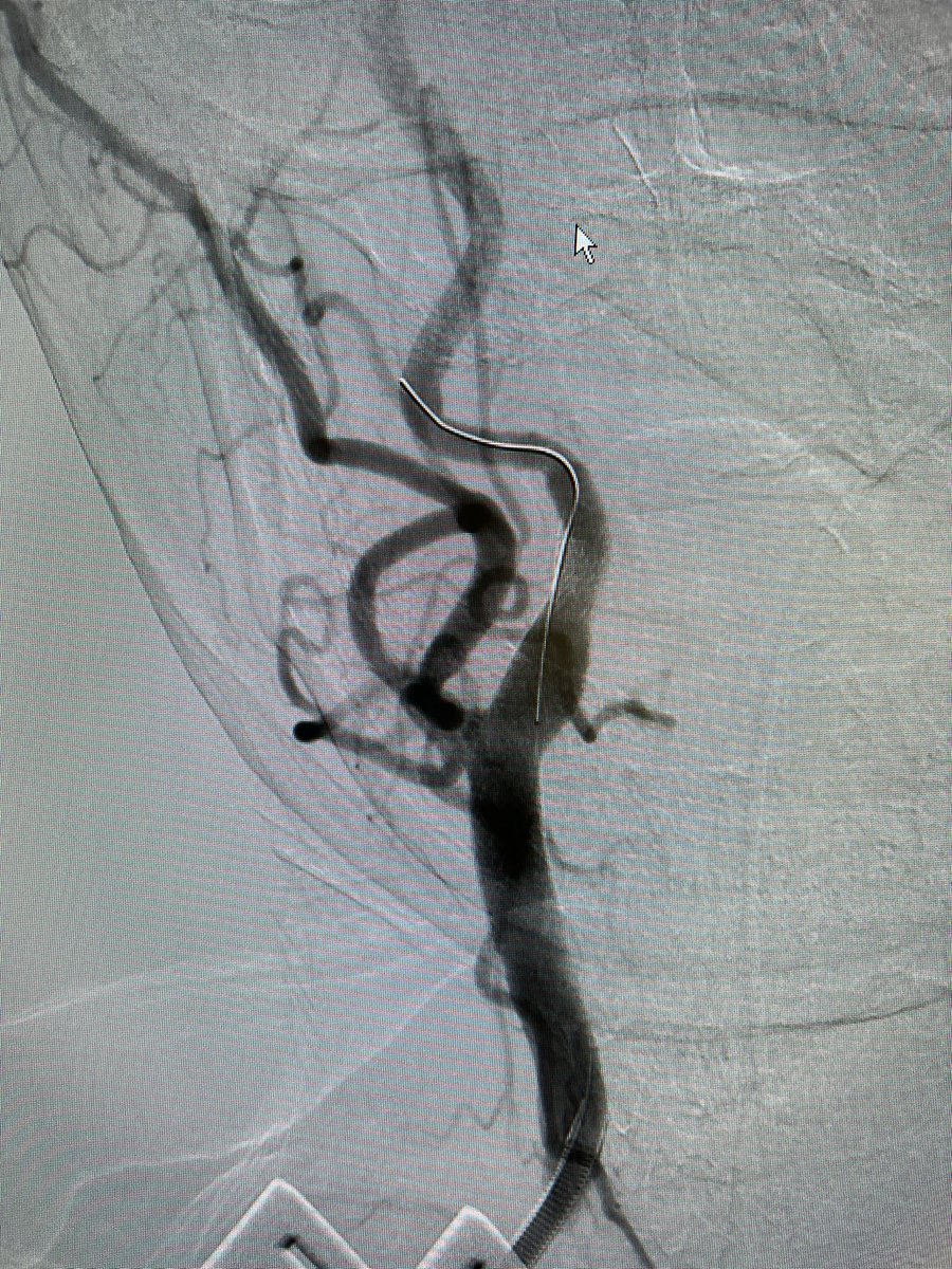 mattsmeds's tweet photo. Love to see #FlowReversal doing what it’s supposed to be doing. Got to love @SilkRoadMed #TCAR. https://t.co/GfD6UlSAl2