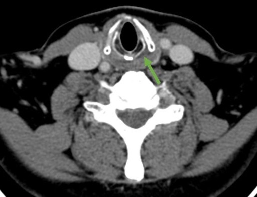 Jessica Wen, MD (@jessicajwen) on Twitter photo This one read the book. Medialized and thickened AE fold. Dilated pyriform sinus. Atrophied true vocal fold. Enlarged laryngeal ventricle. AND beautiful case of atrophy of the posterior cricoarytenoid muscle (green), the icing on top! Left true vocal cord paralysis <a href="/CLTRadiology/">Charlotte Radiology</a> This one read the book. Medialized and thickened AE fold. Dilated pyriform sinus. Atrophied true vocal fold. Enlarged laryngeal ventricle. AND beautiful case of atrophy of the posterior cricoarytenoid muscle (green), the icing on top! Left true vocal cord paralysis <a href="/CLTRadiology/">Charlotte Radiology</a>