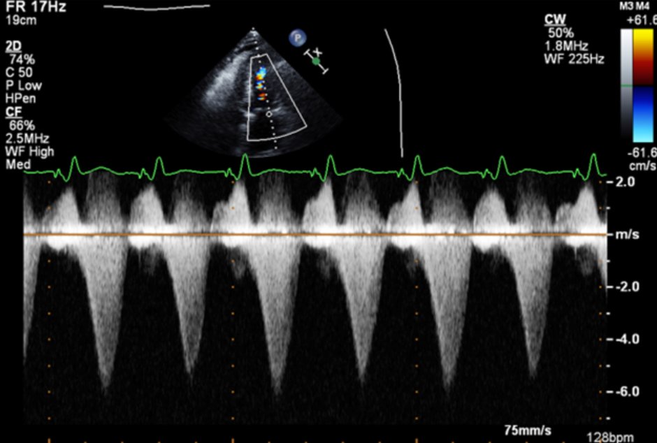#CriticalCareQuiz

A 75-year-old man has urosepsis; no prior history. BP 95/52, HR 124, lactate 6. TTE shows EF 75%. VTI is 60 cm from pulsed wave Doppler. LVOT diameter is 2 cm, which yields CO 23.4 L/min. MV CW Doppler is also shown. Why is CO so high?

#SCCMSoMe